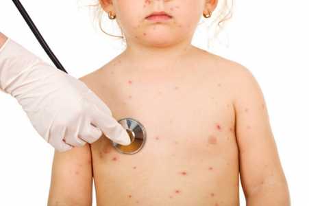 33 de copii bolnavi de varicelă la Școala Gimnazială ”Nicu Albu”, ZCH NEWS - sursa ta de informații