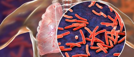 Proiect pentru sănătate: Testare gratuită pentru tuberculoză în 20 de localități nemțene, ZCH NEWS - sursa ta de informații