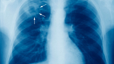 Program de depistare a tuberculozei, ZCH NEWS - sursa ta de informații