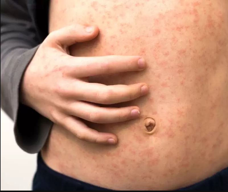 Numărul cazurilor de rujeolă, în creștere în Neamț